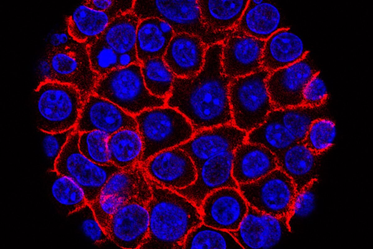 Pancreatic Cancer Breakthrough: Could This New Pill Be The Game Changer We’ve Waited